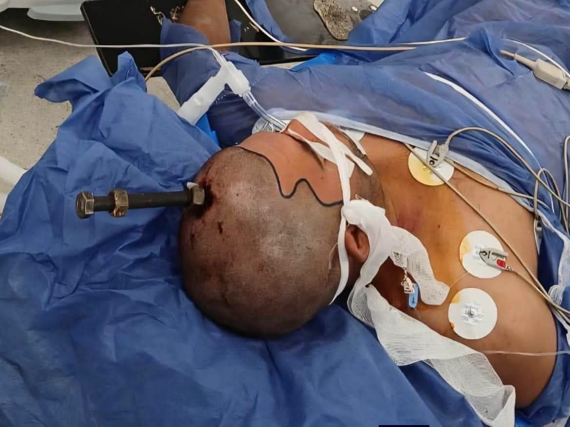 أدوات جراحية متطورة استخدمها أطباء قصر العيني في الجراحة الدقيقة التي استغرقت 4 ساعات.